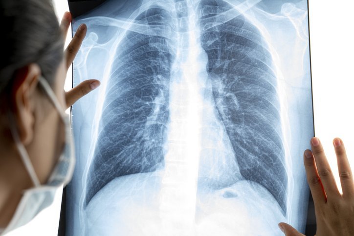 Mulher morre após receber transplante de pulmão infectado com covid-19