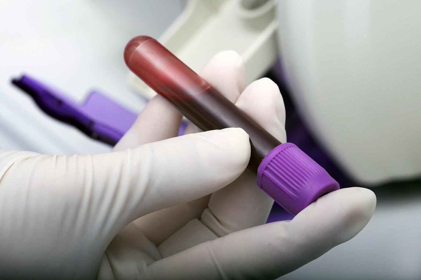 Cientistas pesquisam exame de sangue para diagnosticar Alzheimer