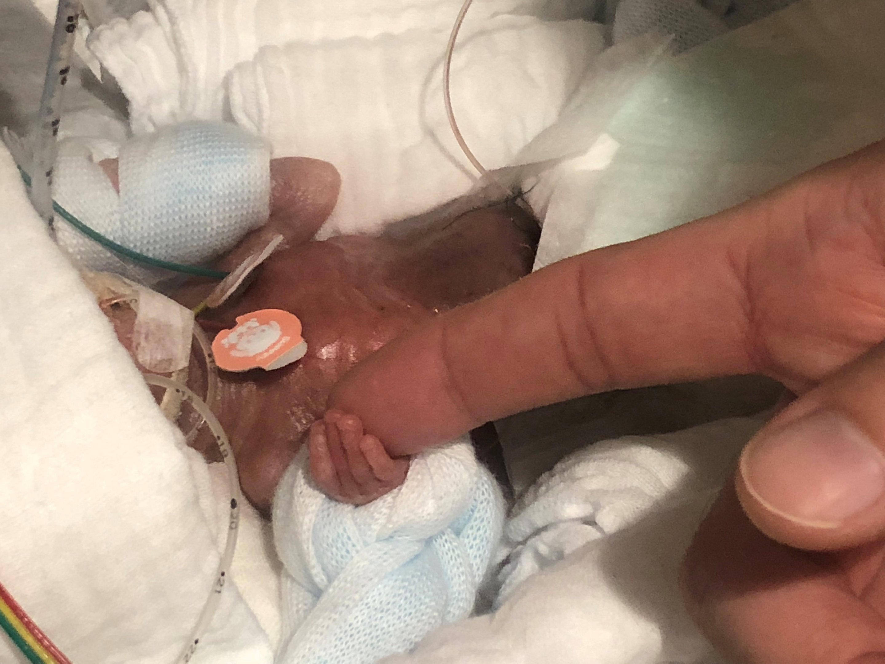 Menor Bebe Do Mundo Deixa O Hospital Apos Cinco Meses Exame