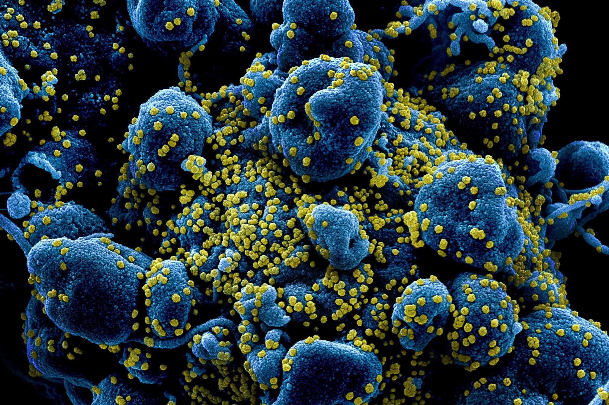 Imagens mostram coronavírus atacando células humanas | Exame